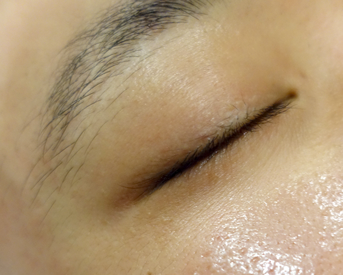 눈가 비립종 치료 후